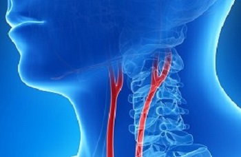 carotid artery disease life insurance with health medical conditions carotid artery disease life insurance with health medical conditions