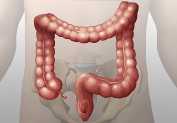 diverticulosis life insurance with medical conditions diverticulosis life insurance with medical conditions