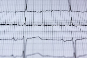 arrhythmia life insurance with medical conditions