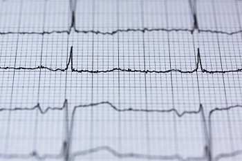 ekg abnormalities life insurance with medical conditions